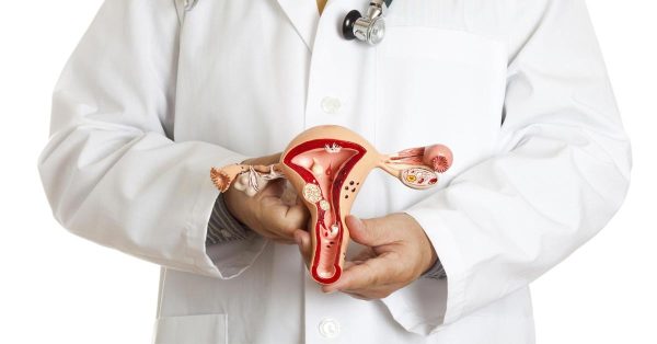 Các bác sĩ hiện vẫn chưa xác định được nguyên nhân trực tiếp gây u xơ tử cung