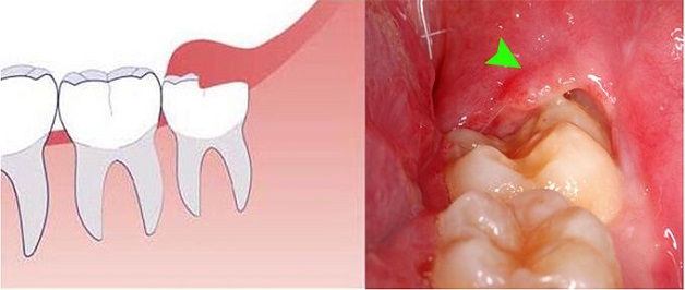 Bệnh viêm lợi trùm là bệnh lý răng miệng phổ biến, thường xuất hiện trong quá trình mọc răng khôn