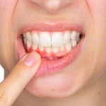 GIẢI ĐÁP: Bị viêm lợi có nên lấy cao răng không? 