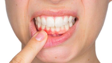 GIẢI ĐÁP: Bị viêm lợi có nên lấy cao răng không? 