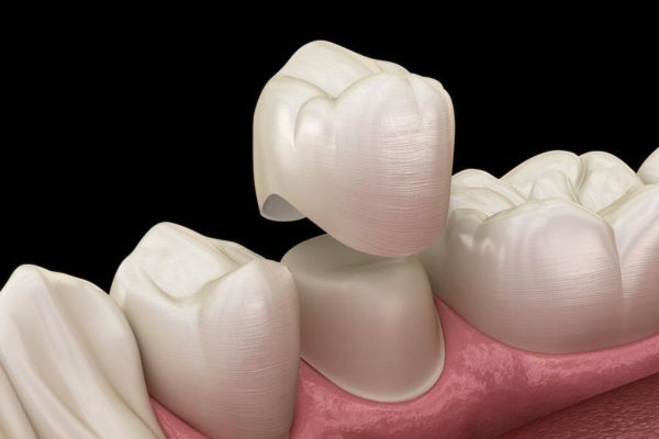 Bọc răng sức - Giải pháp hoàn hảo trong việc khắc phục khiếm khuyết răng miệng