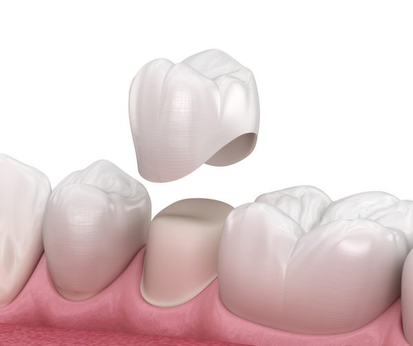 Bọc răng sứ và những điều cần biết khi bọc sứ bao gồm quy trình, tuổi thọ, cách chăm sóc răng miệng....