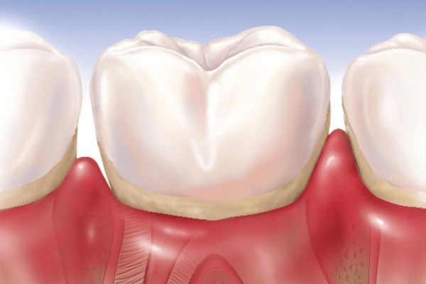 Vệ sinh răng miệng kém khoa học khiến mảng bám tích tụ nhiều gây sưng nướu răng