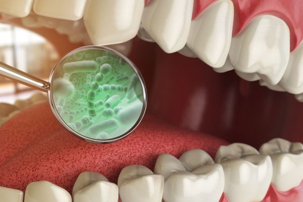 Vi khuẩn có hại là tác nhân cơ bản dẫn tới tình trạng sâu răng ở nhiều người