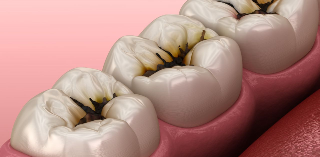 Những nguyên nhân chính gây sâu răng ở người lớn là gì?
