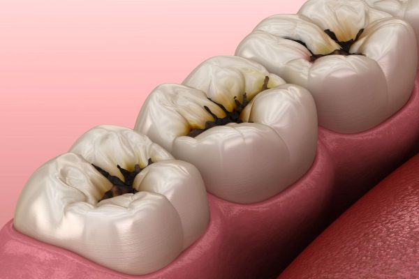 Sâu răng hình thành do sự tấn công của các tác nhân có hại, biểu hiện thành các chấm, lỗ đen trên bề mặt răng