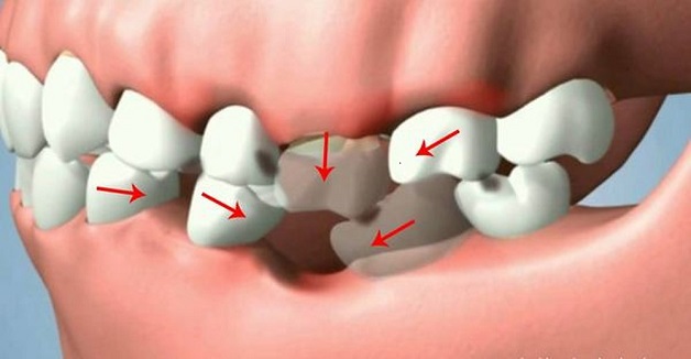 Sâu răng có thể dẫn đến nguy cơ mất răng hoàn toàn 