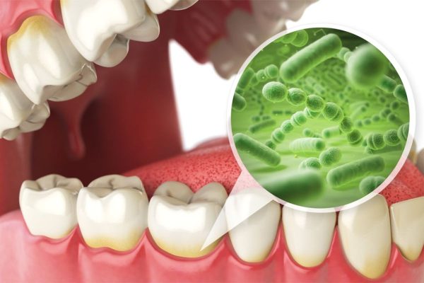 Cao răng thường bám chắc ở thân răng hoặc dưới mép lợi, là môi trường lý tưởng cho vi khuẩn phát triển