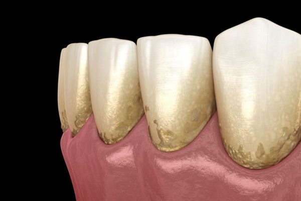 Cao răng có màu trắng đục, vàng hoặc nâu sẫm ở thân răng hoặc dưới mép lợi