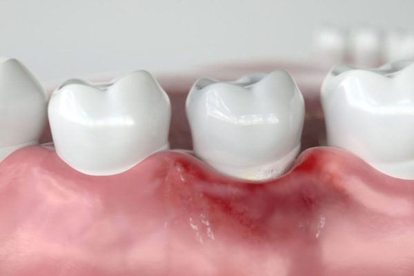 Cao răng không được loại bỏ thường xuyên khiến răng dễ mắc các bệnh lý nguy hiểm như sâu răng, viêm nha chu...