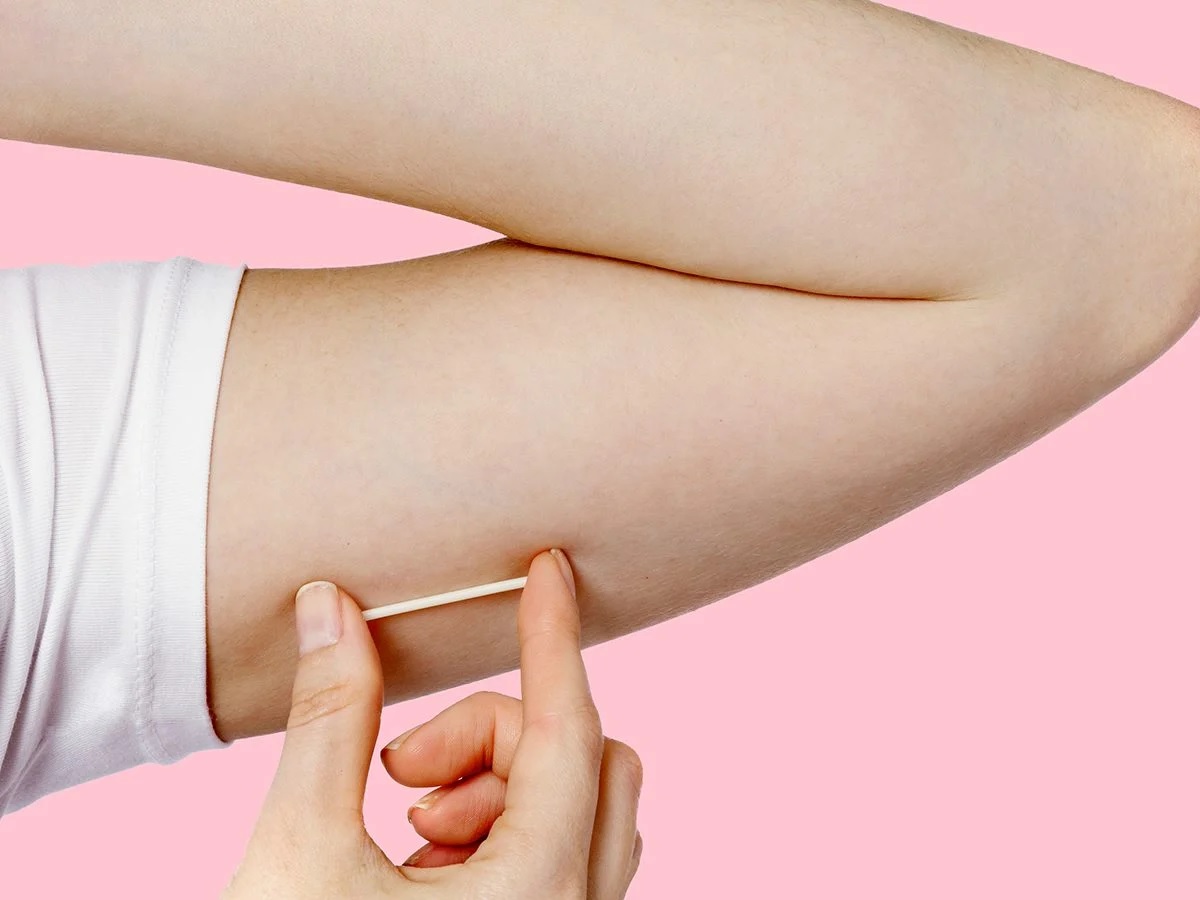 Cấy que tránh thai là thủ thuật cấy que có chứa hormon vào vùng da dưới cánh tay
