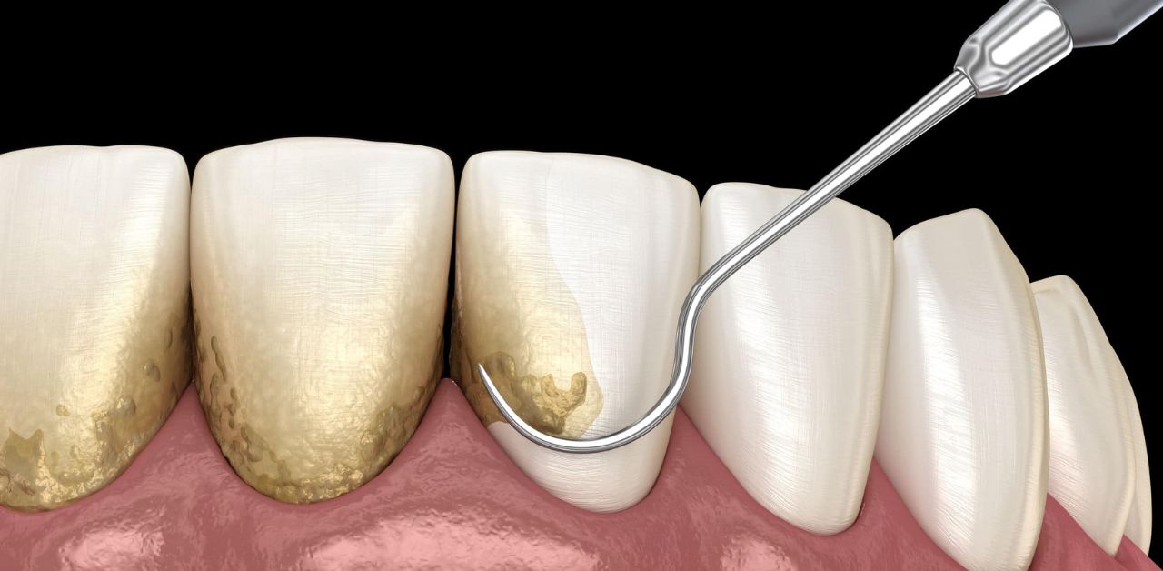 Sau khi lấy cao răng, có được đánh răng ngay sau không?