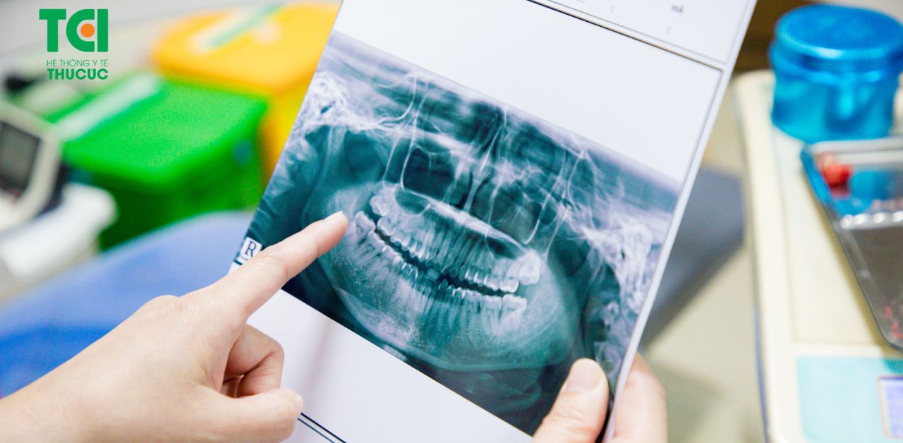 Nguyên nhân gây viêm nhiễm sau khi nhổ răng khôn là gì?
