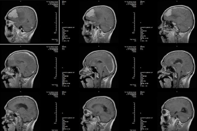 Chỉ định chụp CT scan sọ não khi nào?