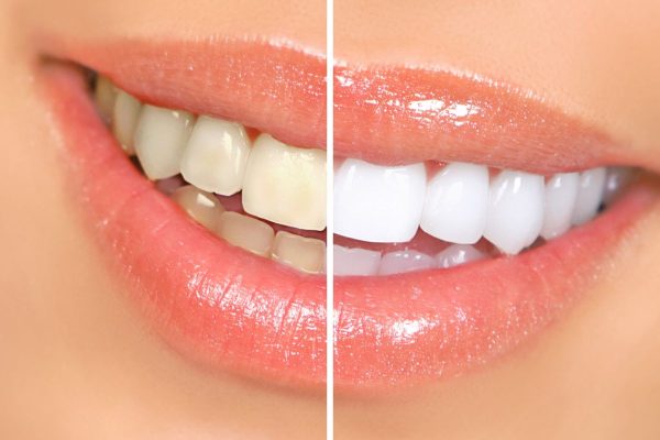 Dán veneer thường được áp dụng cho những người gặp phải một số khiếm khuyết về răng miệng như khấp khểnh lệch lạc nhẹ, ố màu...