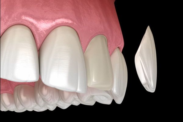 Bác sĩ sẽ tiến hành mài răng với kích thước khoảng 0,3-0,5mm để tạo khoảng trống cho mặt dán sứ