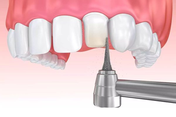 Dán sứ veneer có mài răng không còn tùy thuộc vào tình trạng răng miệng và chỉ định của bác sĩ đối với từng người