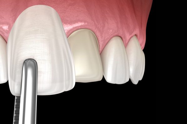 Mặt dán sứ được làm từ các chất liệu cao cấp, an toàn với sức khỏe răng miệng