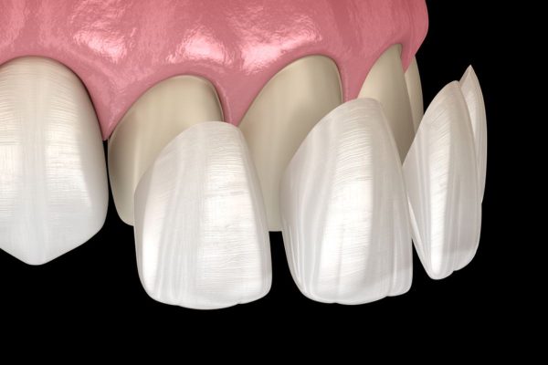 Phương pháp dán sứ veneer có thể khắc phục hiệu quả những khiếm khuyết về răng miệng như ố vàng, thưa, hở kẽ, khấp khểnh nhẹ...