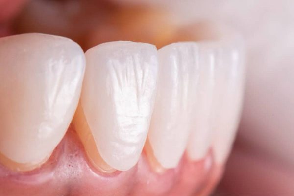 Miếng dán sứ veneer kích thước mỏng được gắn lên trên răng thật để phục hình thẩm mỹ cho răng