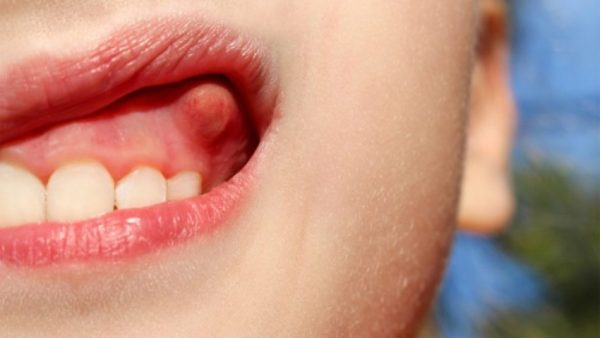Viêm lợi trùm là tình trạng viêm các mô mềm (bao gồm nướu và các nang răng) xung quanh răng đang mọc.
