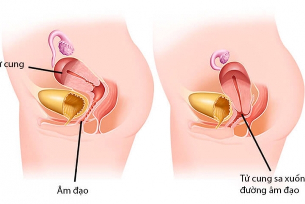 Đẻ mổ có bị sa tử cung không - Sa tử cung là hiện tượng mà tử cung phụ nữ có chiều hướng tụt xuống gần với khu vực âm đạo