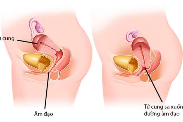 Hình ảnh tử cung bị sa biến chứng ảnh hưởng sức khỏe