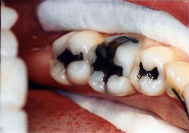 cách chữa sâu răng hàm tại nhà