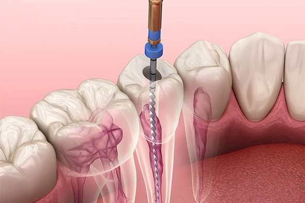 Điều trị tủy răng là biện pháp lấy đi phần tủy bị viêm hoặc đã chết nằm ở phía sâu bên trong thân răng, làm sạch khoảng trống bên trong răng cũng như tạo hình dạng cho ống tủy.