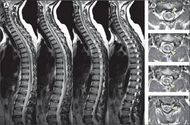 Khi nào cần chụp cộng hưởng từ cột sống thắt lưng?