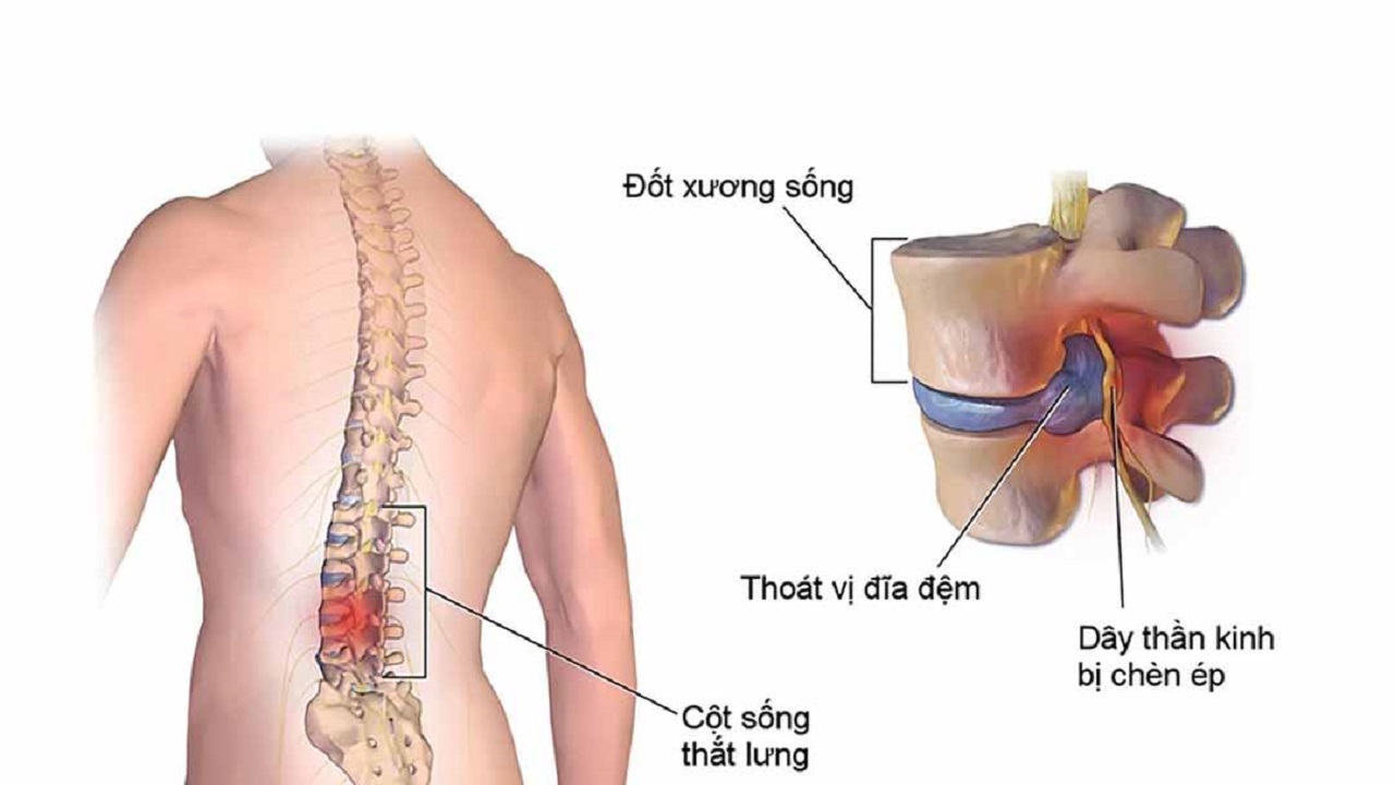 Ai nên sử dụng phương pháp chụp cộng hưởng từ cột sống thắt lưng? 
