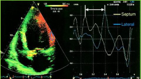 Giải đáp: Khi nào cần siêu âm doppler tim?
