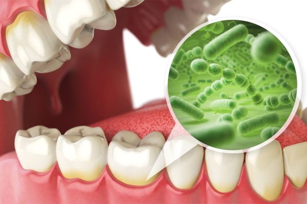 Vi khuẩn từ cao răng là tác nhân gây ra một số bệnh lý răng miệng và bệnh lý toàn thân