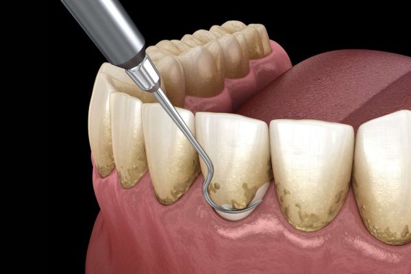 Lấy cao răng có tác dụng gì theo các bác sĩ nha khoa là làm sạch mảng bám, giúp răng chắc khỏe hơn