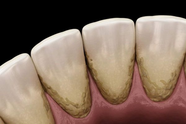 Cao răng hình thành và bám chắc ở bề mặt thân răng hoặc dưới mép lợi