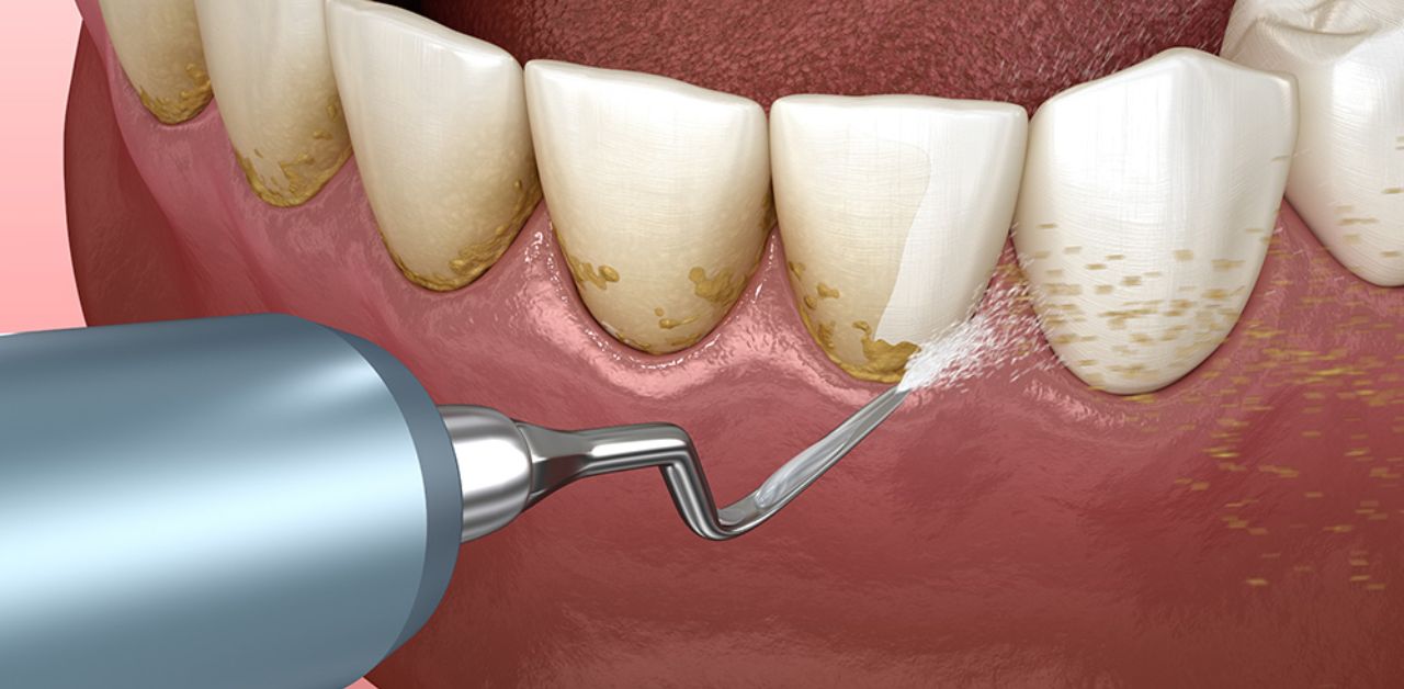 Lấy cao răng có ảnh hưởng đến mô mềm xung quanh răng không?
