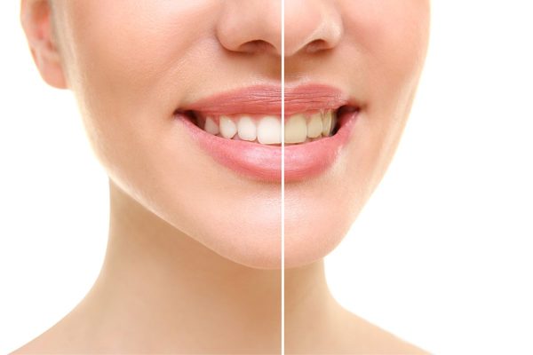 Bọc sứ là một trong những phương pháp cải thiện hiệu quả các khiếm khuyết của răng, giúp răng trở nên đều, thẩm mỹ hơn