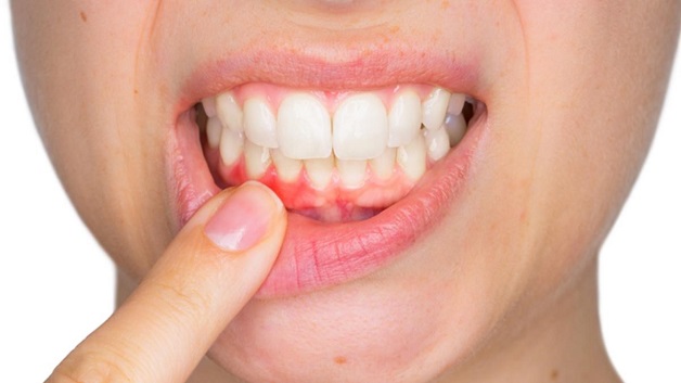 Sưng chân răng hay viêm chân răng là bệnh lý về tổ chức quanh răng bị sưng tấy, viêm nhiễm