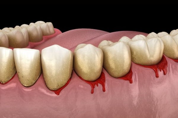 Cao răng gây ra tình trạng sâu răng, viêm lợi, viêm nha chu, hôi miệng, thậm chí là có thể gây ra một số bệnh lý toàn thân