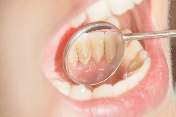 Cao răng bám chắc ở thân răng, mép lợi, là nơi vi khuẩn trú ngụ gây ra nhiều bệnh lý nha khoa nguy hiểm