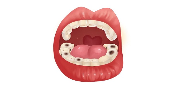 Viêm chân răng là bệnh lý răng miệng liên quan đến những tổ chức ở xung quanh răng gây tình trạng nướu sưng tấy và viêm nhiễm.
