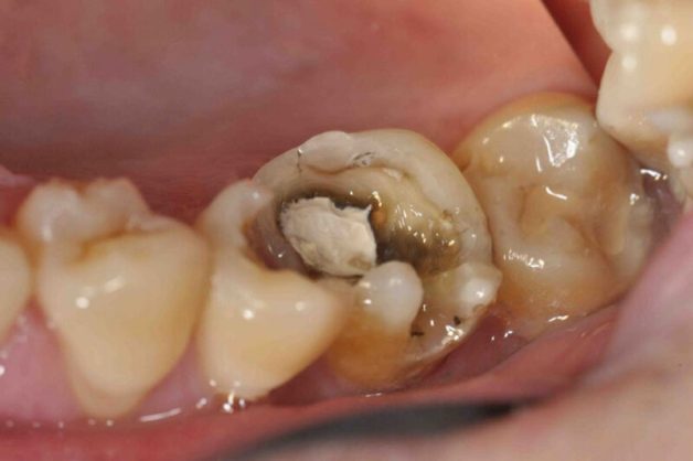 cách chữa sâu răng hiệu quả