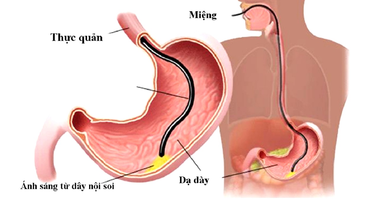 Пролапс желудка в пищевод. Гастроскопия желудка язва желудка.