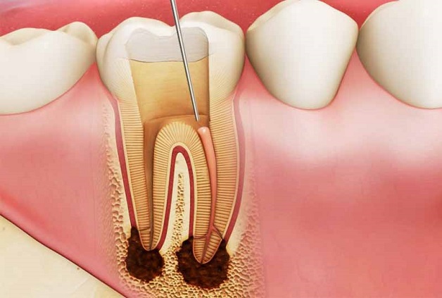 Sưng nướu răng có thể là dấu hiệu của áp xe chân răng 