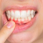Nướu răng bị sưng nhức là dấu hiệu của bệnh gì? 