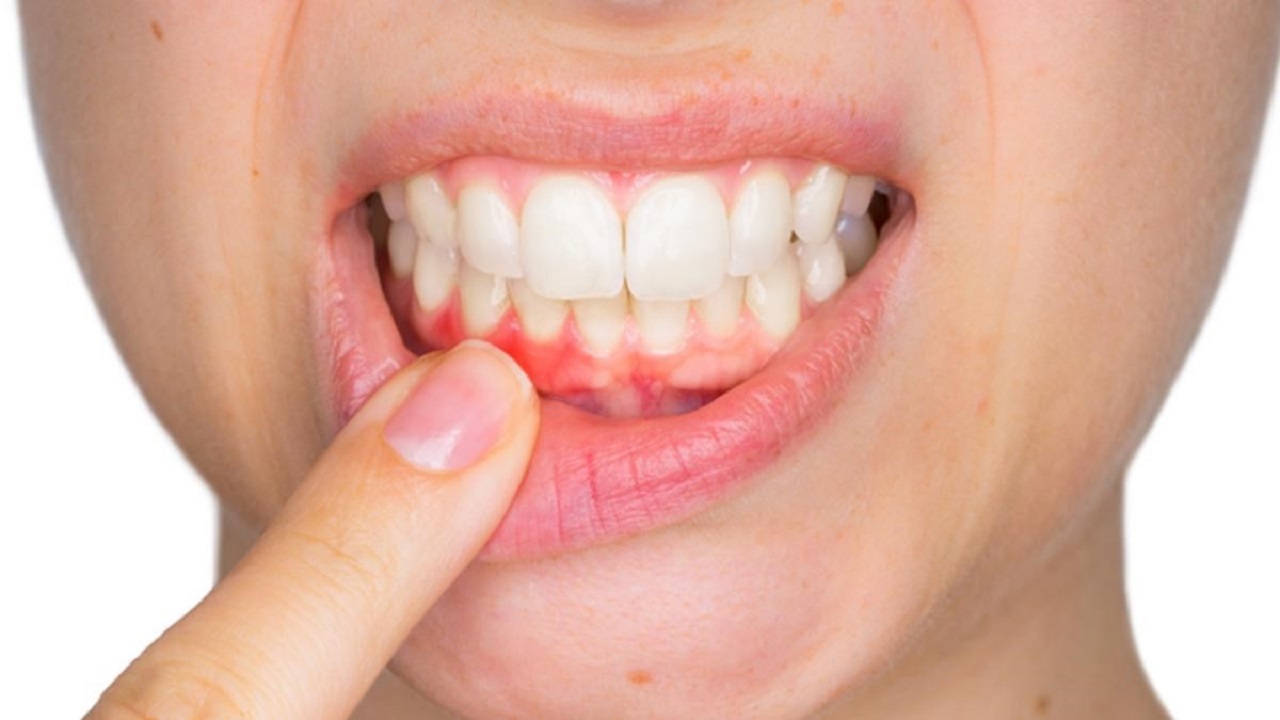 Tất cả mọi người đều có khả năng bị sưng nướu răng do sâu răng không?
