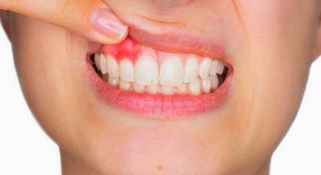 Nướu răng bị sưng nhức, hay còn gọi sưng lợi xuất phát từ nguyên nhân nướu bị viêm nhiễm dẫn đến bị sưng tấy, dễ chảy máu khi chỉ có tác động nhỏ vào nướu. 