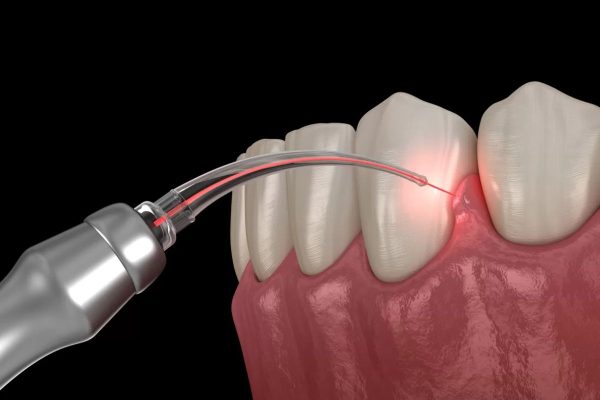 Với những trường hợp hở lợi > 3mm, bác sĩ sẽ chỉ định phẫu thuật hở lợi bằng việc cắt viền nướu kết hợp làm dài thân răng