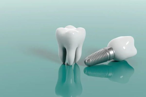 Có nhiều loại răng sứ Implant được sử dụng trong phục hình nha khoa hiện nay