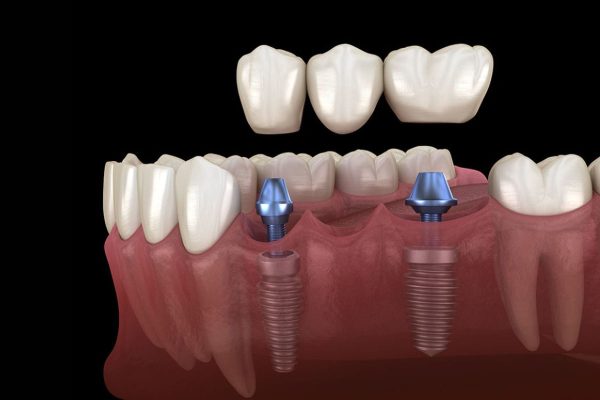 Mão sứ được gắn lên trên trụ Implant thông qua khớp nối Abutment là kỹ thuật phục hình răng sứ trên Implant